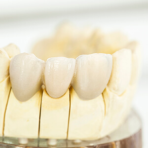 Ceramic model of dental crown supported bridge