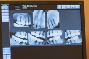 Digital x-rays of teeth on computer monitor