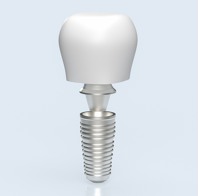 Illustration of a dental crown being placed onto a dental implant