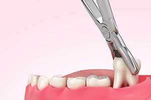 Illustration of a tooth being removed