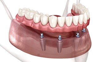 Illustration of All-on-4 dental implants in Sparks, NV