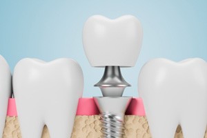 Crown, abutment, and dental implant in Sparks, NV