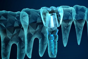 Digital illustration of dental implant in Sparks, NV and teeth 