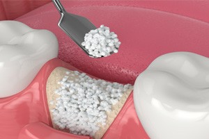 Illustration of bone graft in lower jaw