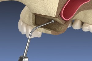 Illustration of bone graft in lower jaw