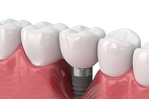 Illustration of a sinus lift in the upper jaw