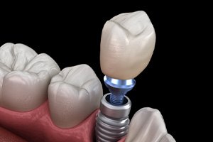 Illustration of crown being attached to dental implant in Sparks, NV