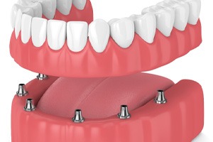 Illustration of implant dentures in Sparks, NV