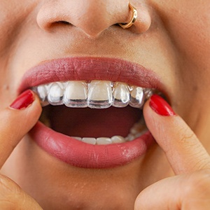 Patient putting clear aligner on top teeth