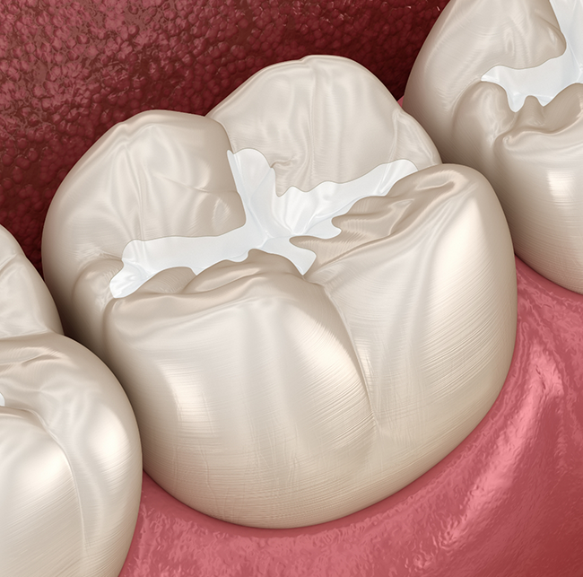 Illustration of teeth with tooth-colored fillings in Sparks