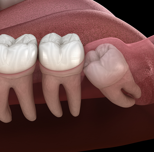Illustration of an impacted wisdom tooth pressing against the adjacent tooth