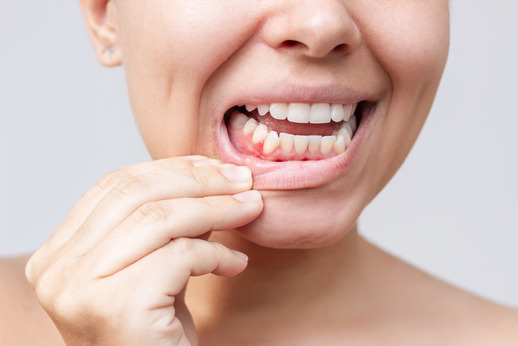 woman showing bump on gums 